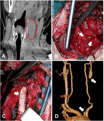 Case Report: Two cases of survival after complete transection of the left common carotid artery